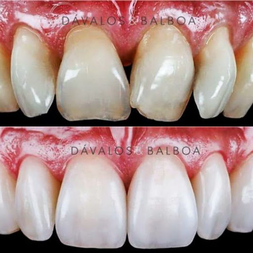 Clínica Dental Dávalos & Balboa- Invisalign Murcia- Implantes dentales- Centro